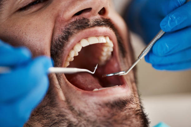 Best Emergency Dental Care for Broken or Chipped Teeth in Olivette, MO